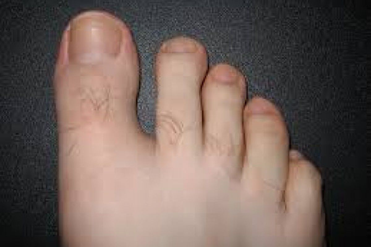 Infeksi penyebab kuku jari menjadi kuning