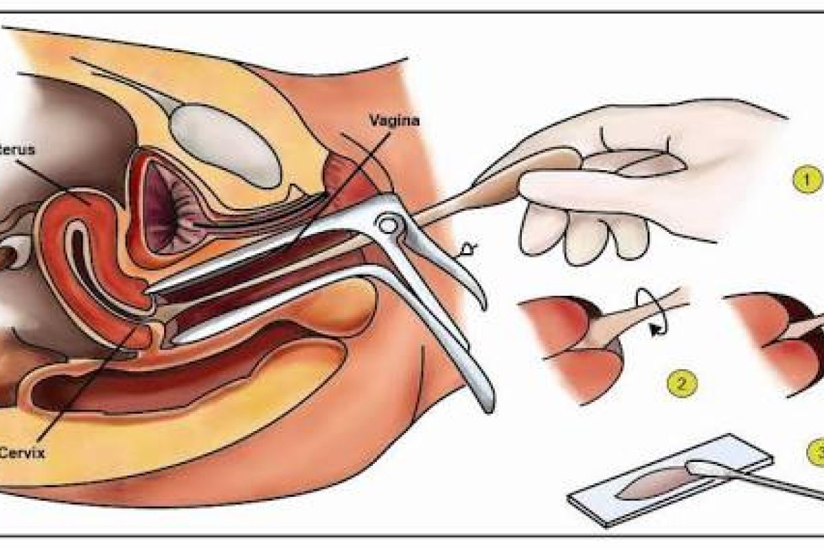 BPJS-Kesehatan Ambon jamin pemeriksaan kanker metode pap smear