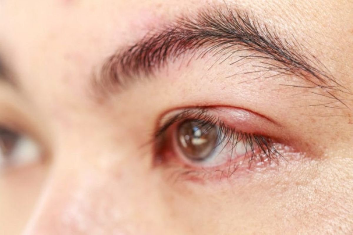 Kurang bersih saat menghapus riasan mata dapat sebabkan penyakit hordeolum
