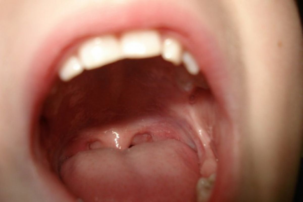 Kenali gejala kanker mulut dengan SAMURI