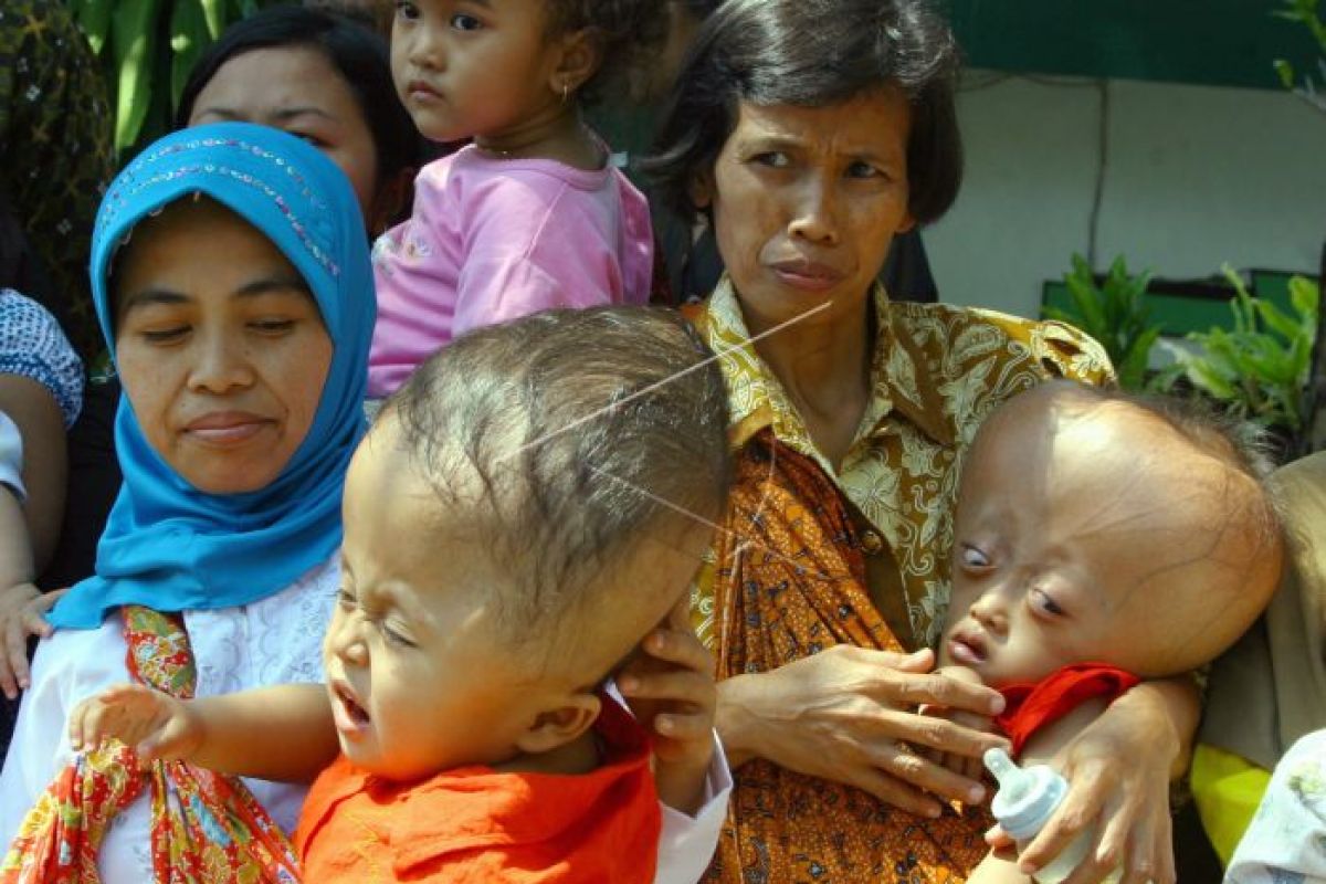 Garuda Indonesia kunjungi penderita hydrochepalus