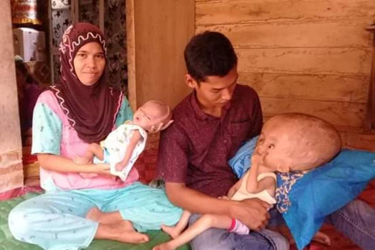 Abang adik menderita hydrosepalus di Pematang Jaya Langkat