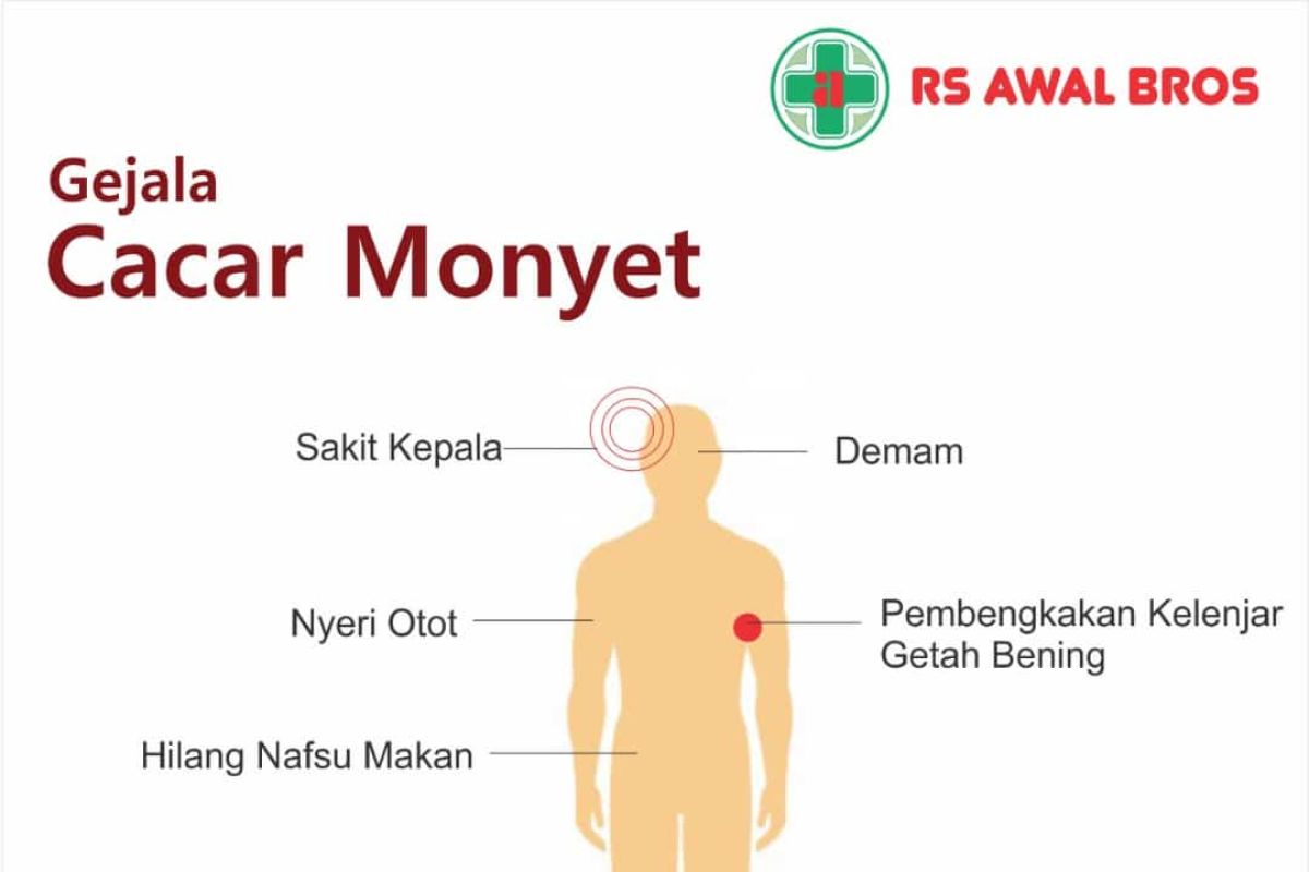 Bandarlampung aman dari cacar monyet