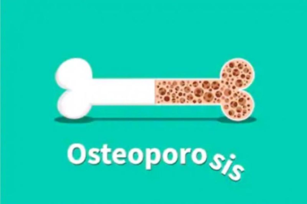 Hari Osteoporosis, enam cara ini hindari  tulang keropos