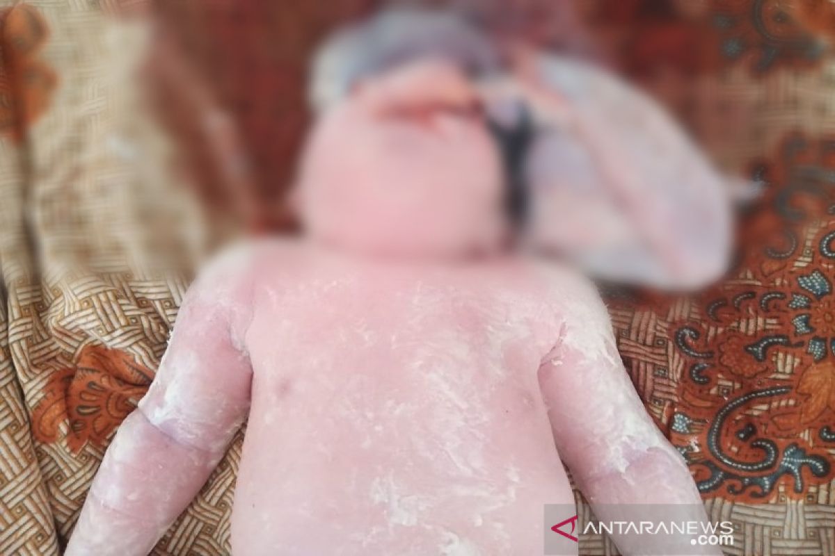 Lagi, bayi Anencephaly lahir di Madina