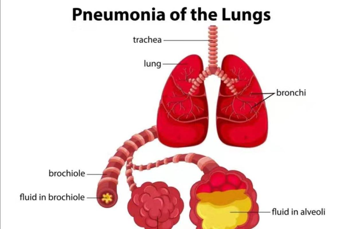 Di China, seorang penderita pneumonia meninggal dan tujuh kritis