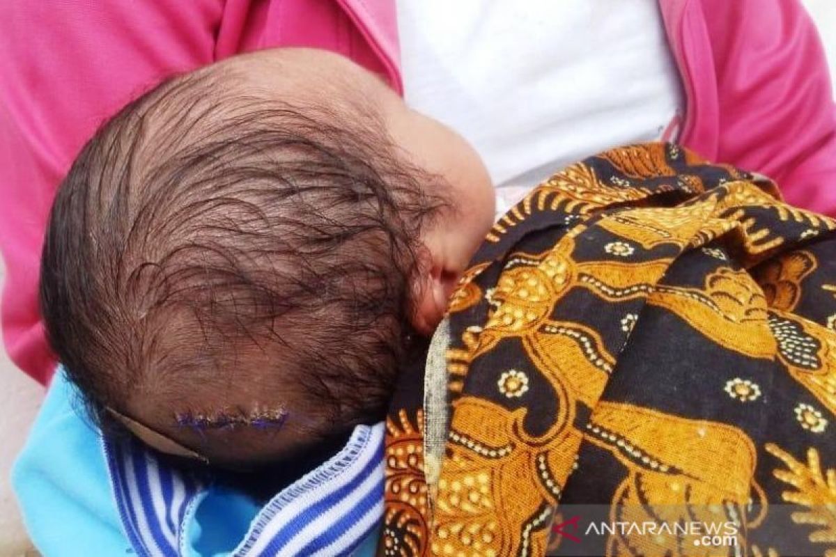 Bayi ini mendapat tujuh jahitan di kepala saat lahir, diduga tersayat alat medis