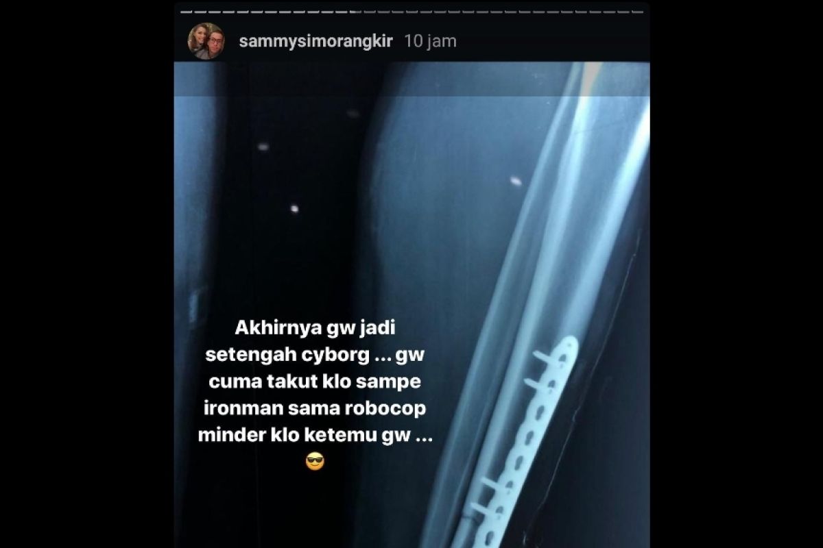 Sammy Simorangkir jalani operasi kaki kiri usai kecelakaan motor