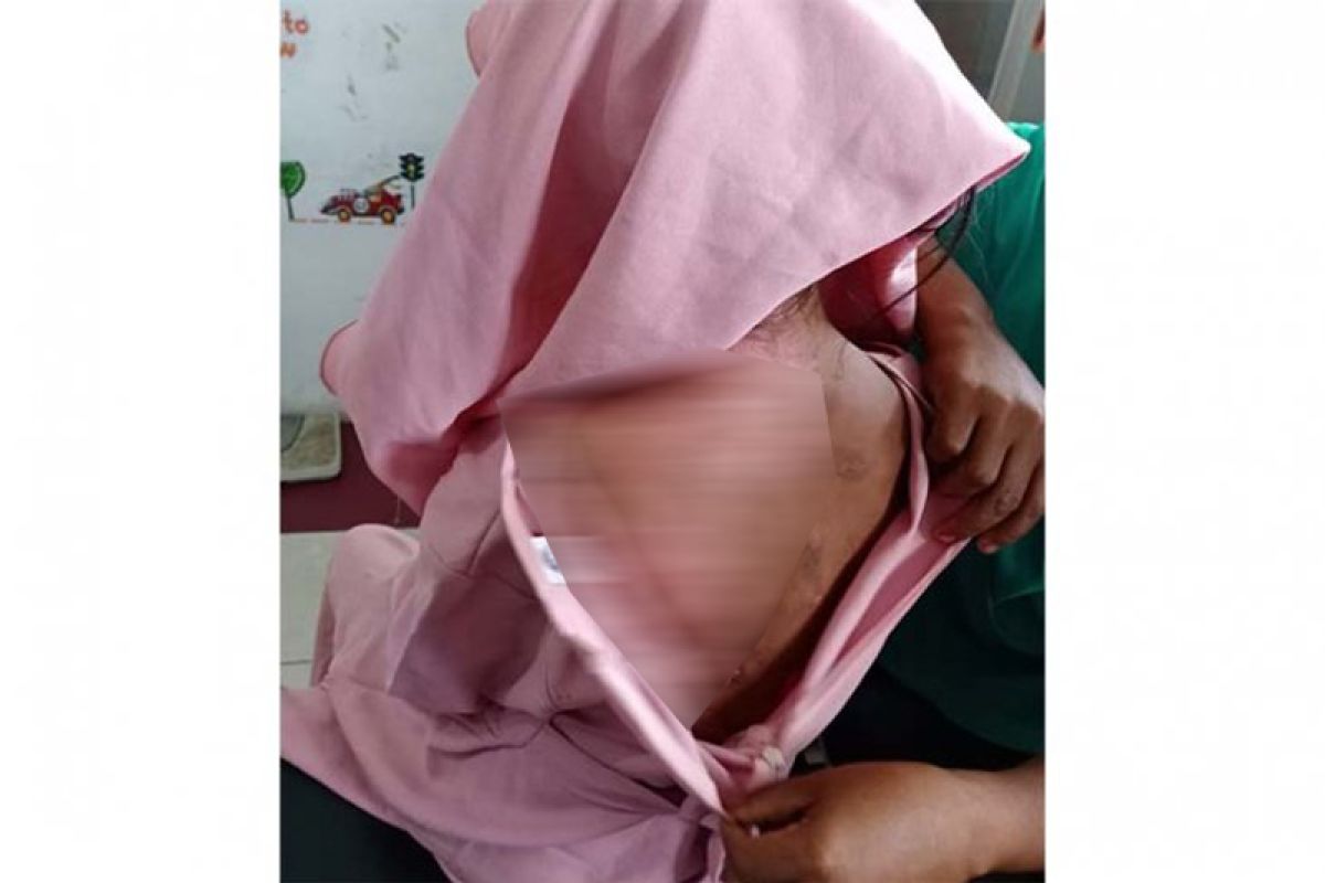 Kulit remaja putri ini melepuh akibat disiram air panas oleh ibu kandungnya