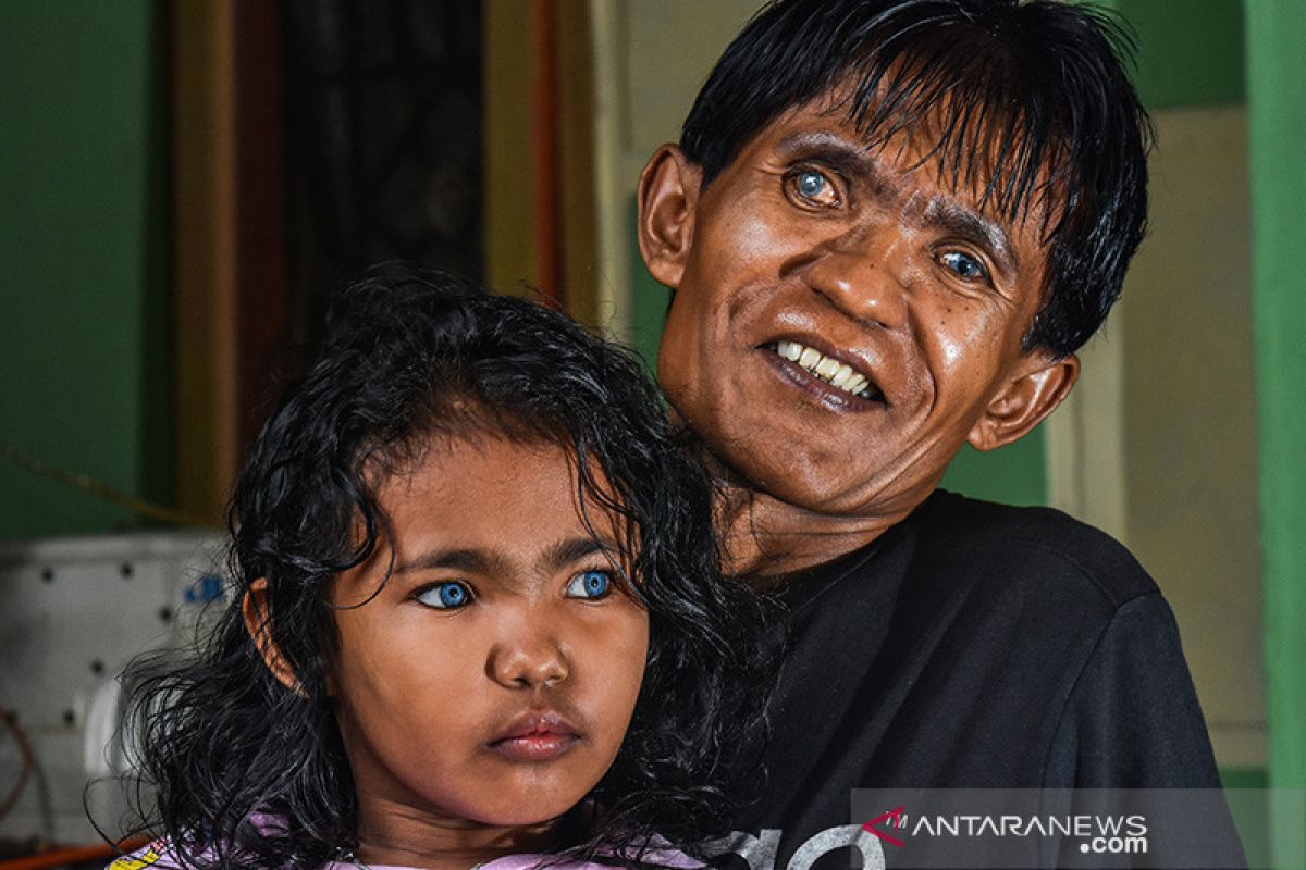 Viral...di balik fenomena anak bermata biru Pekanbaru