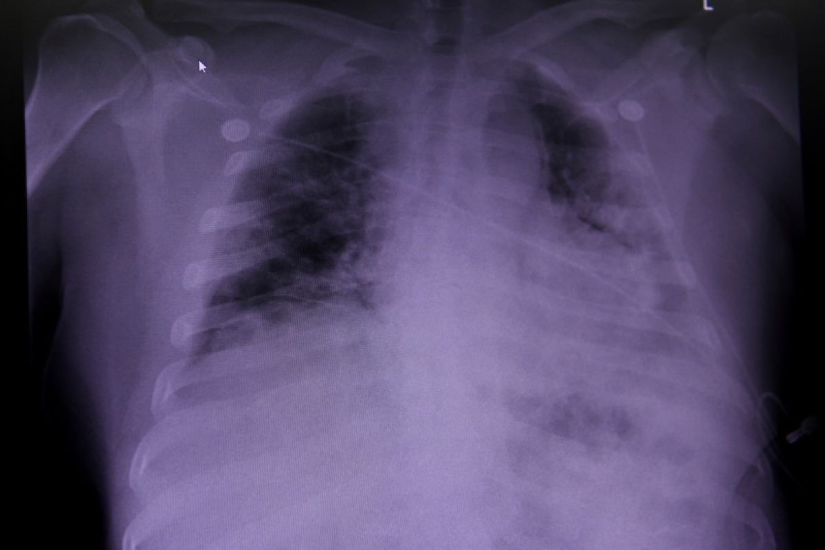 IDAI:  bedakan pneumonia karena COVID-19 atau bakteri dengan tes swab