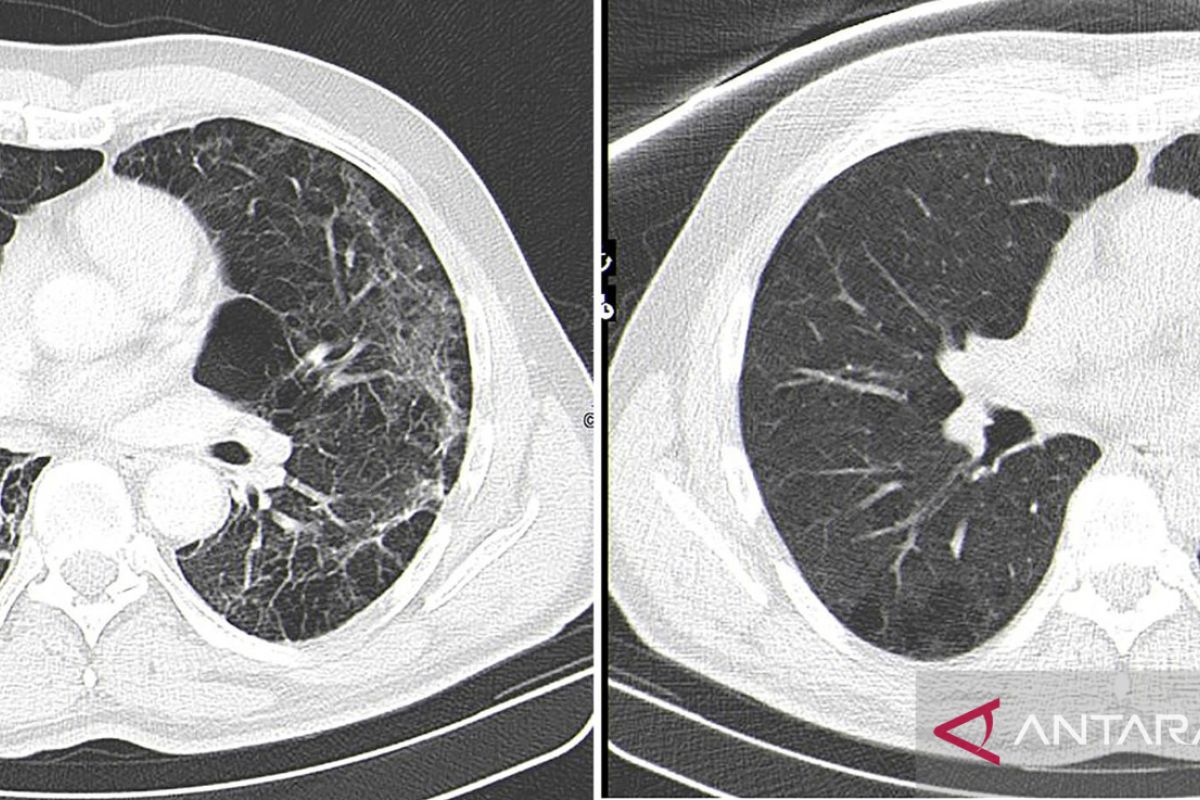 Hoaks! Foto perbandingan paru-paru orang sudah dan belum divaksin COVID-19