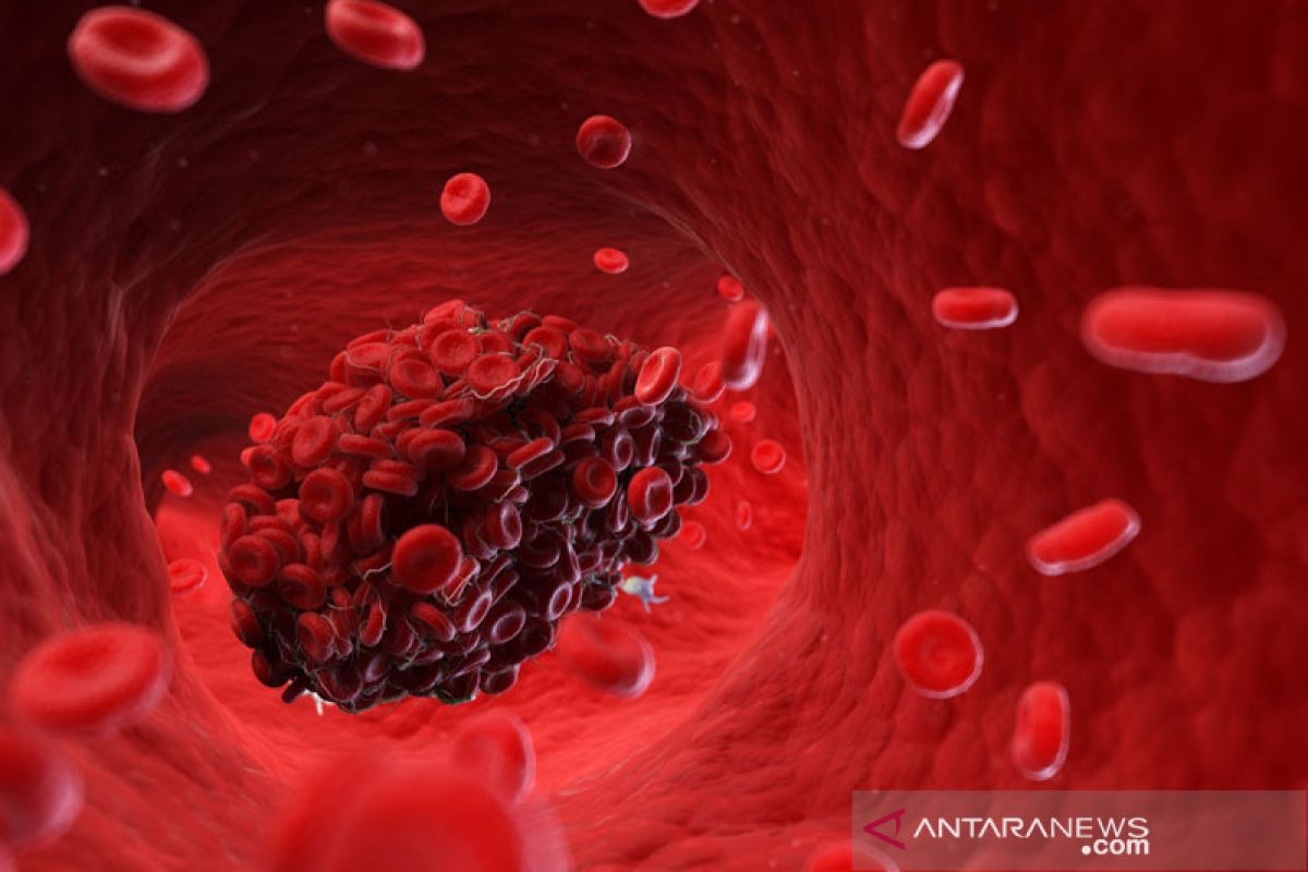 Memahami pembekuan darah akibat COVID-19