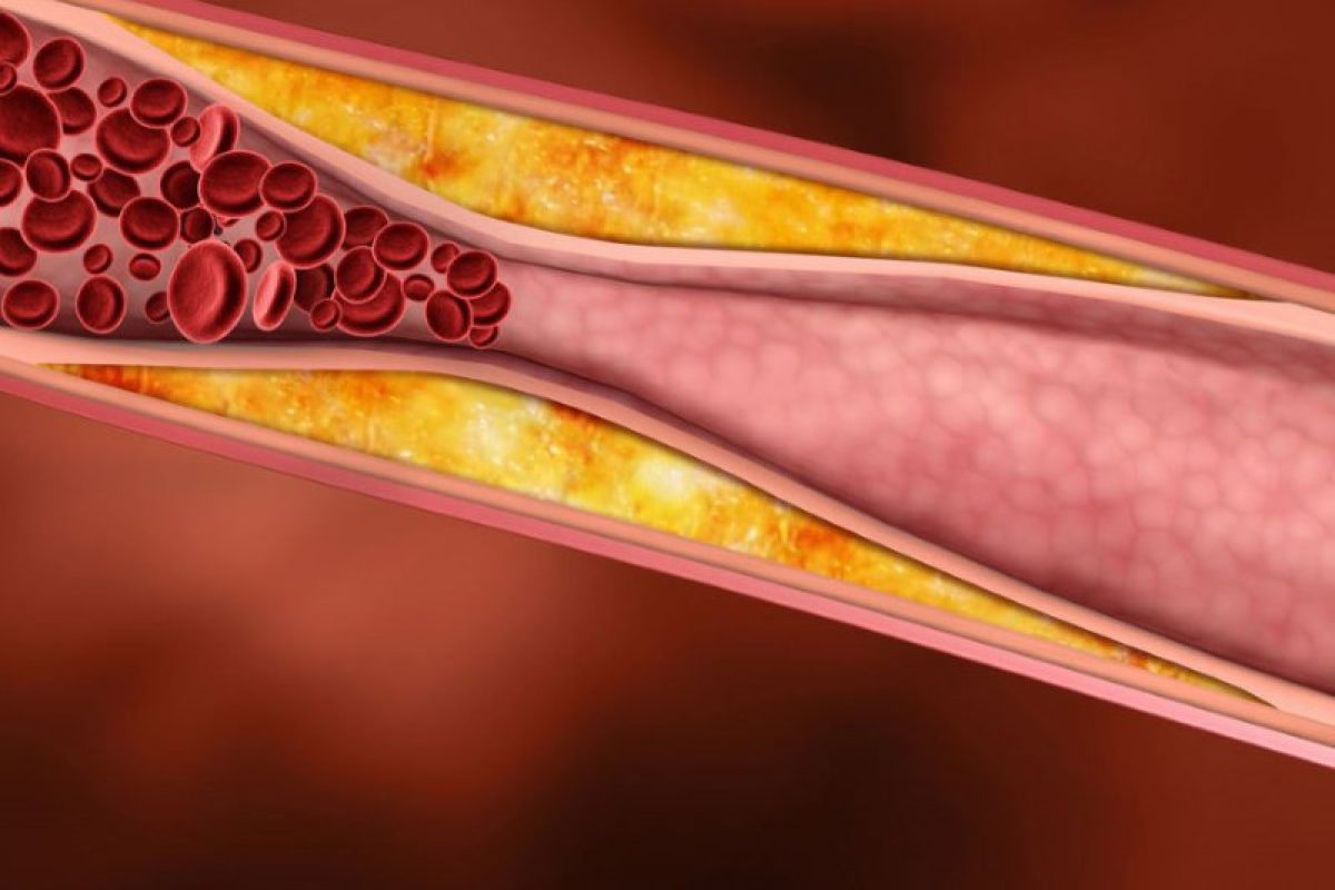 Masyarakat diimbau waspadai gejala Dislipidemia