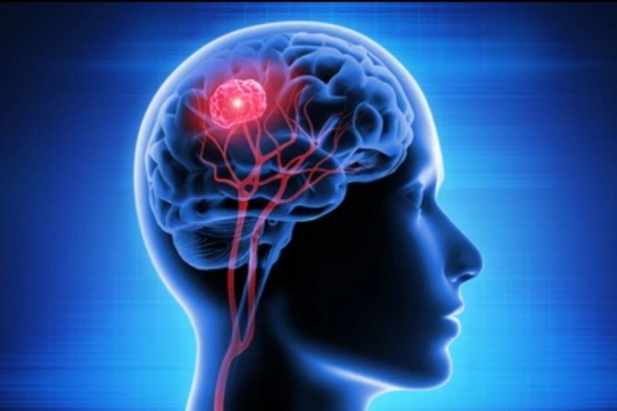 Sakit kepala yang semakin berat bisa jadi indikasi tumor otak