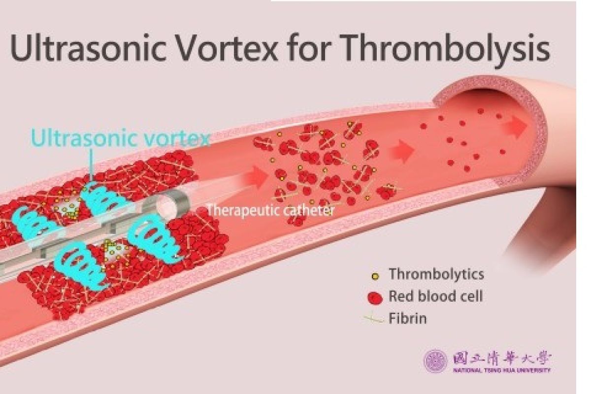 NTHU researchers develop ultrasonic vortex thrombolytic device