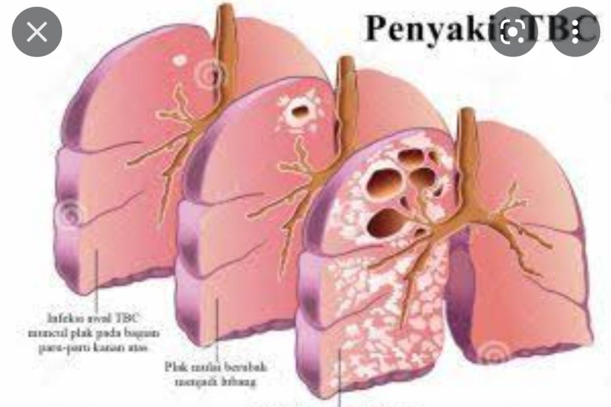 Puluhan warga binaan LP Tulungagung diduga terpapar tuberculosis