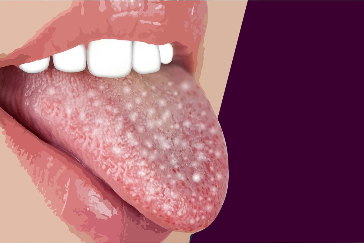 Waspada sariawan lidah sulit sembuh bisa jadi kanker
