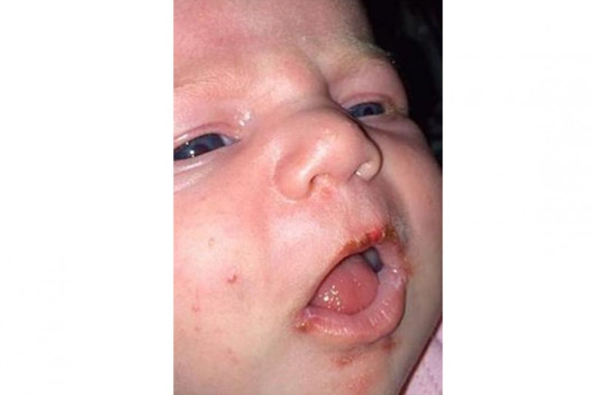 KPA Maluku: Bayi juga bisa terinfeksi herpes simpleks, begini penjelasannya