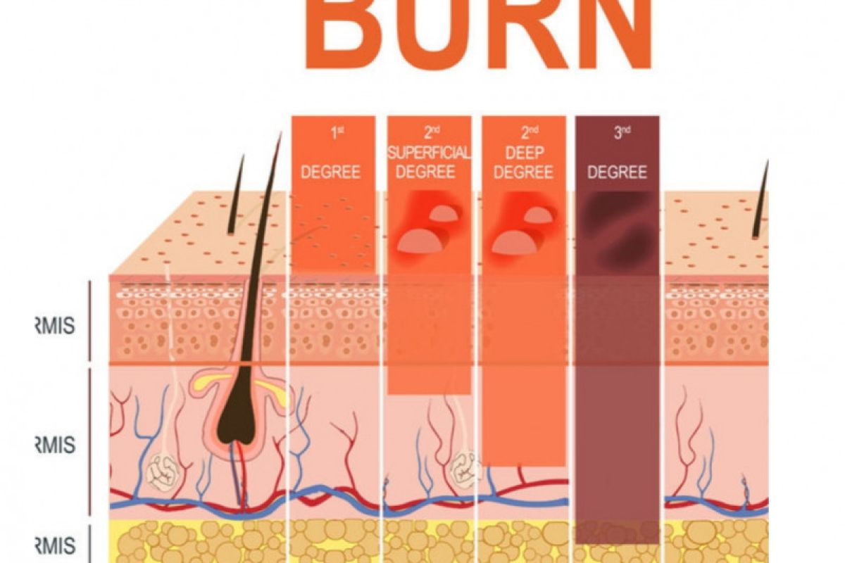 Mengenal 3 Derajat Luka Bakar Dan Cara Perawatannya M 3872
