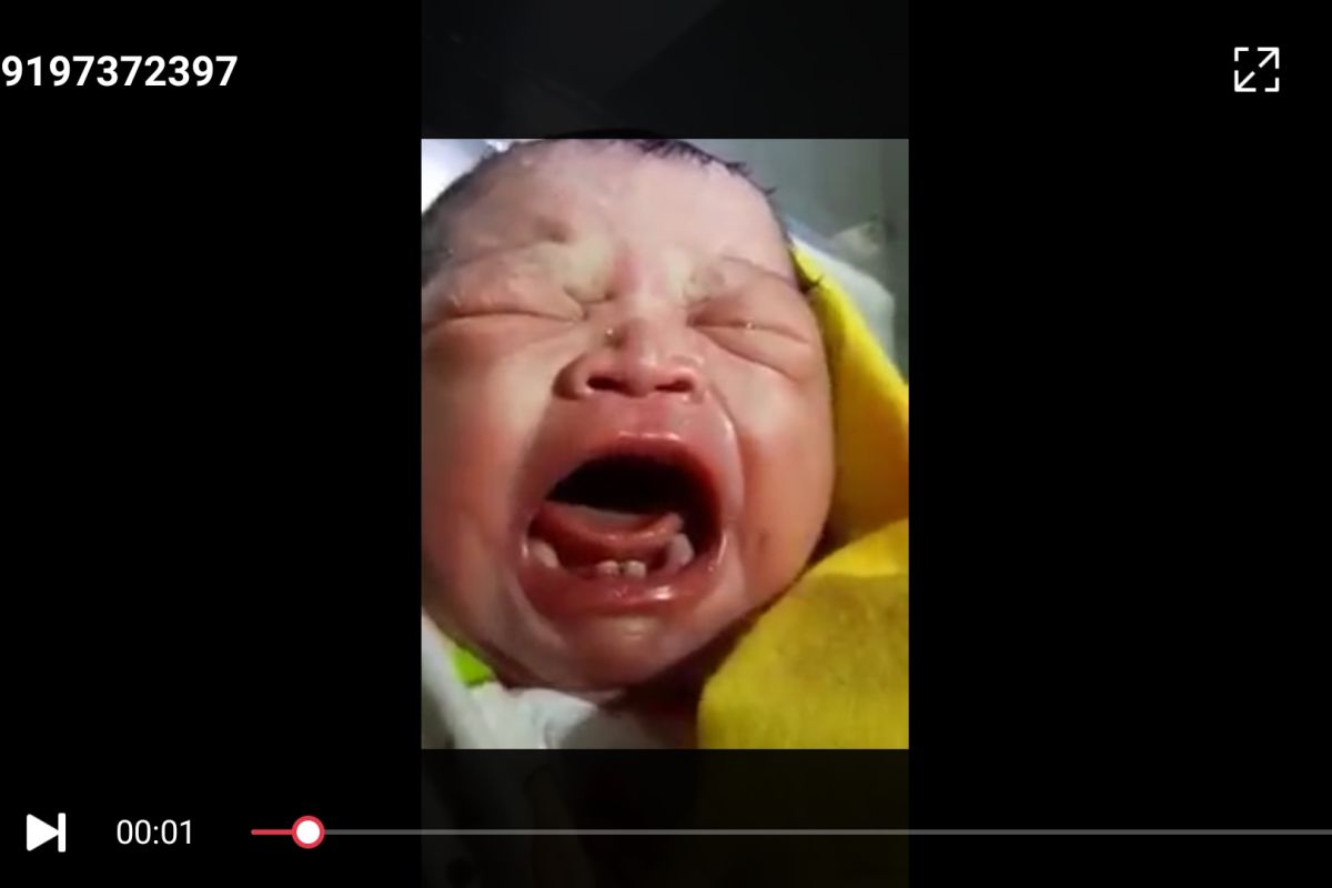 Bayi lahir dan sudah miliki gigi di Labura