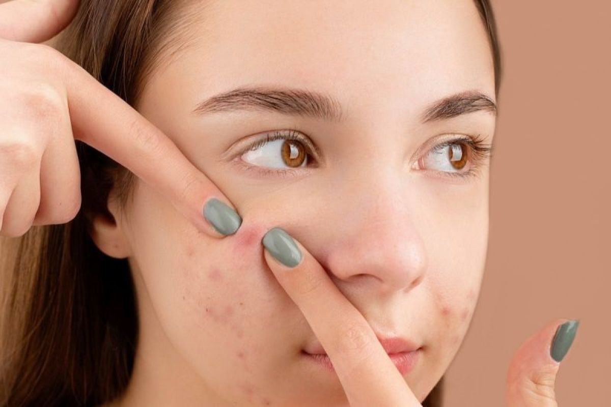 Dokter sebut penggunaan acne patch tak terlalu efektif untuk jerawat