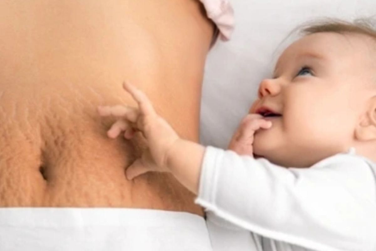 "Stretch marks" bersifat permanen, tapi bisa dikurangi gejalanya