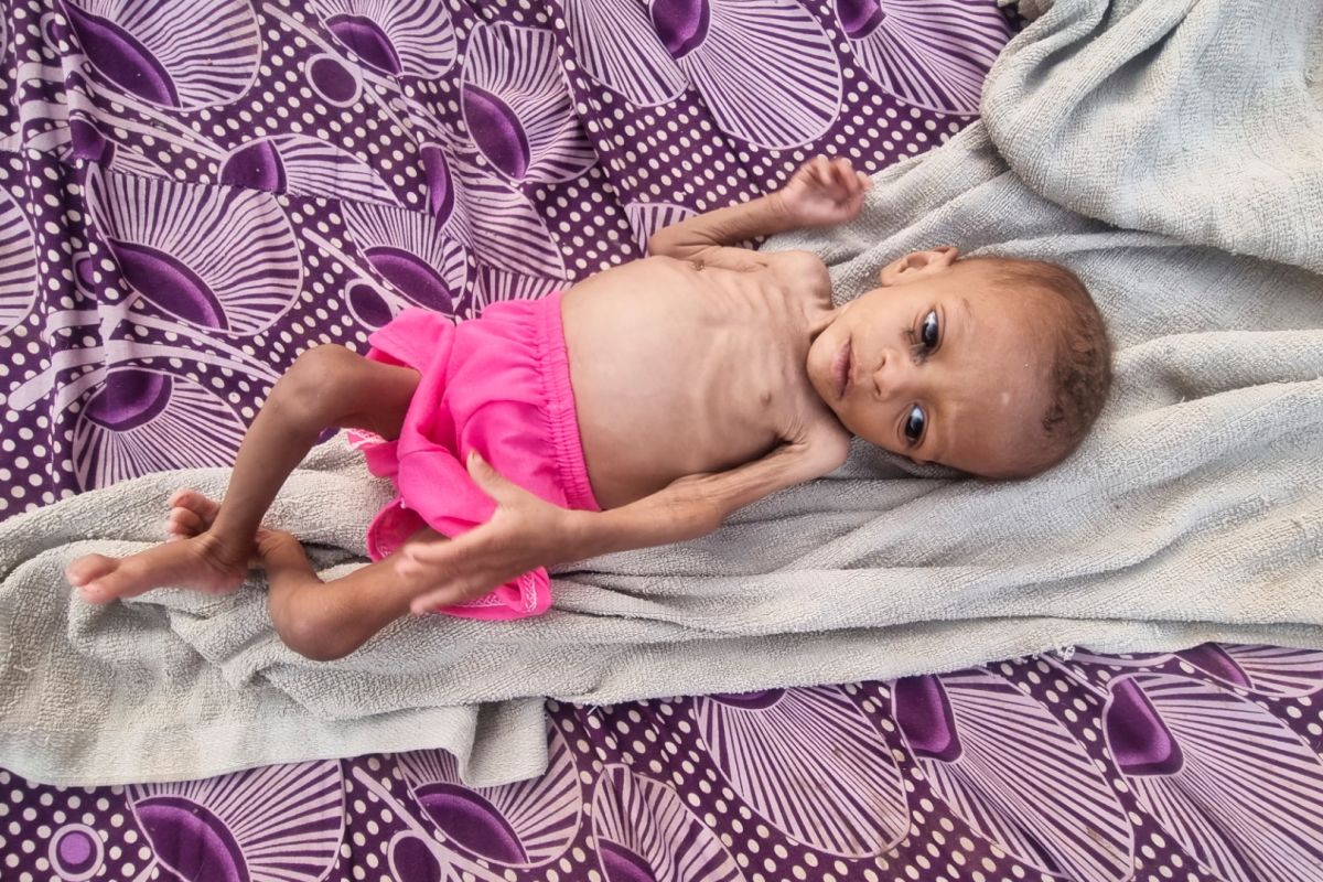 UNICEF peringatkan 'bencana' malnutrisi anak akibat harga naik dan perang