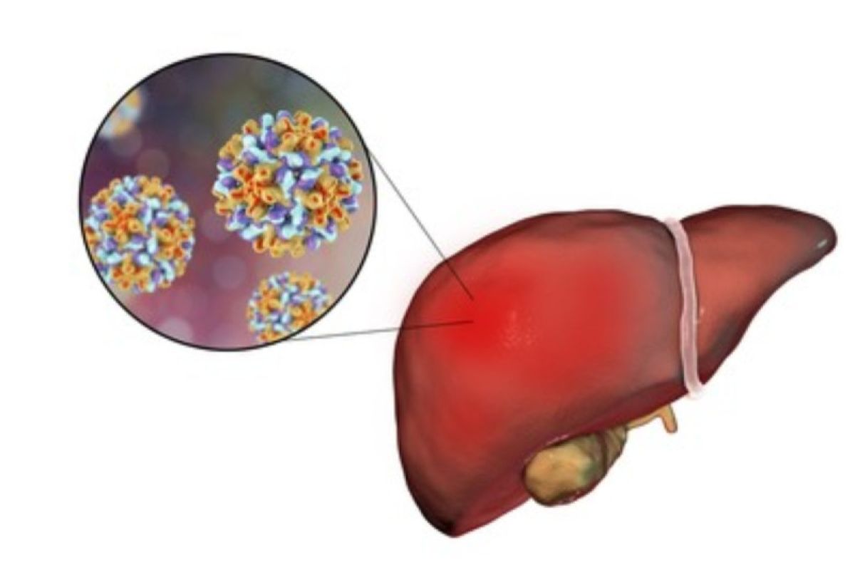 Kemenkes: Dugaan hepatitis akut di Indonesia bertambah 14 kasus