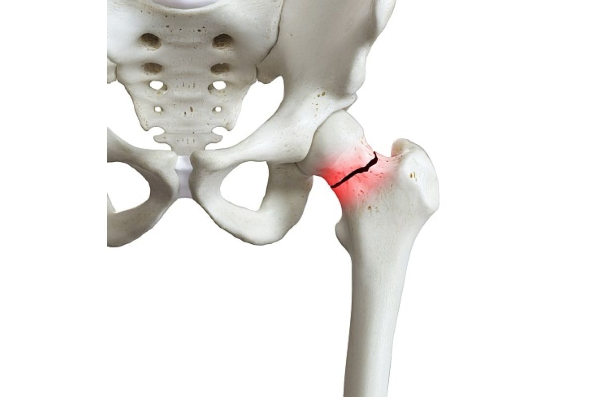 "Menabung tulang" sejak dini cegah osteoporosis