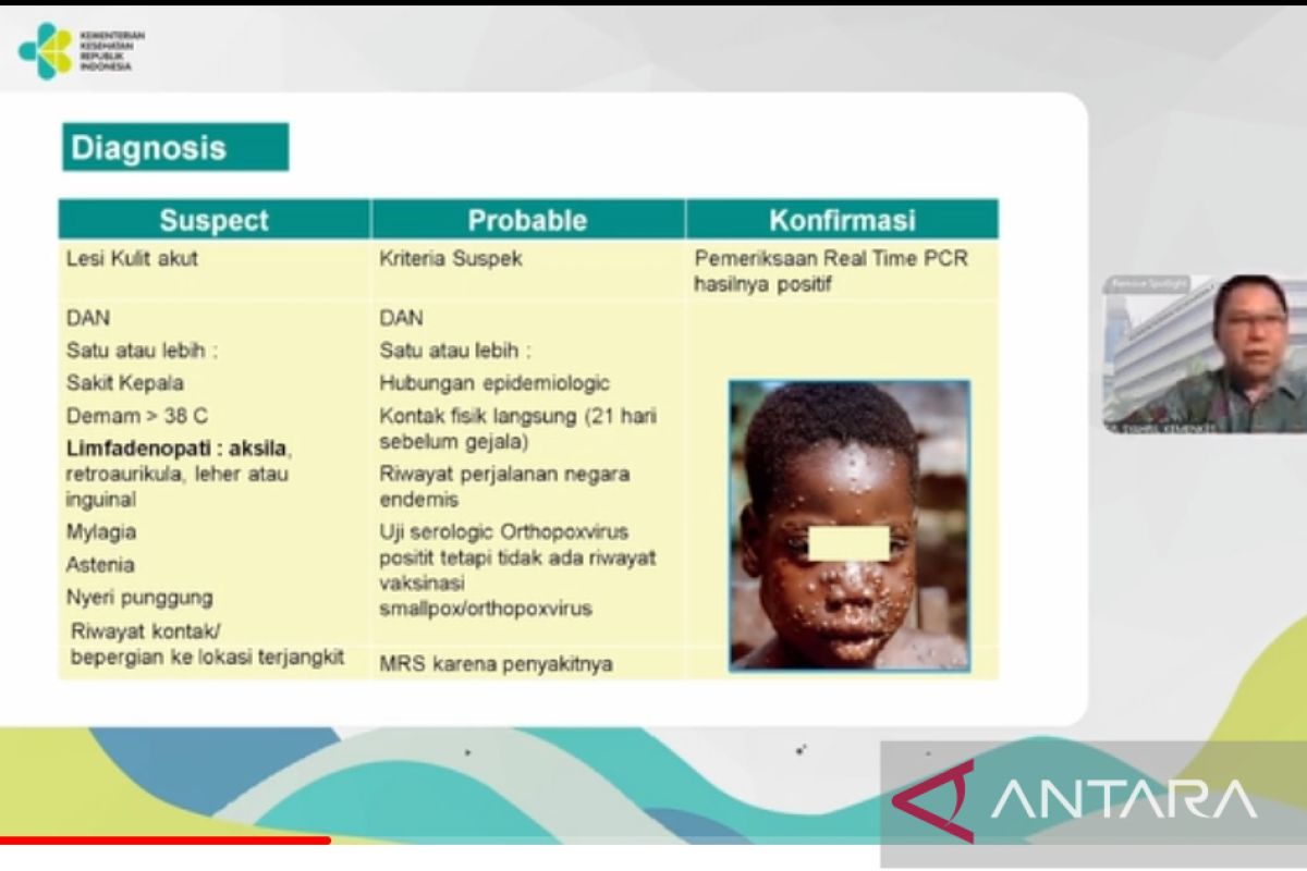Kemenkes: Demam tinggi dan benjolan lipatan kulit ciri khas cacar monyet