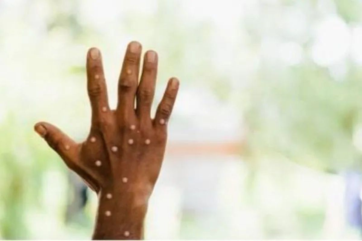 Support strengthening of public education on monkeypox: govt