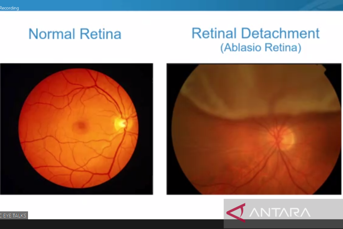 Bercak hitam di mata tanda awal ablasio retina
