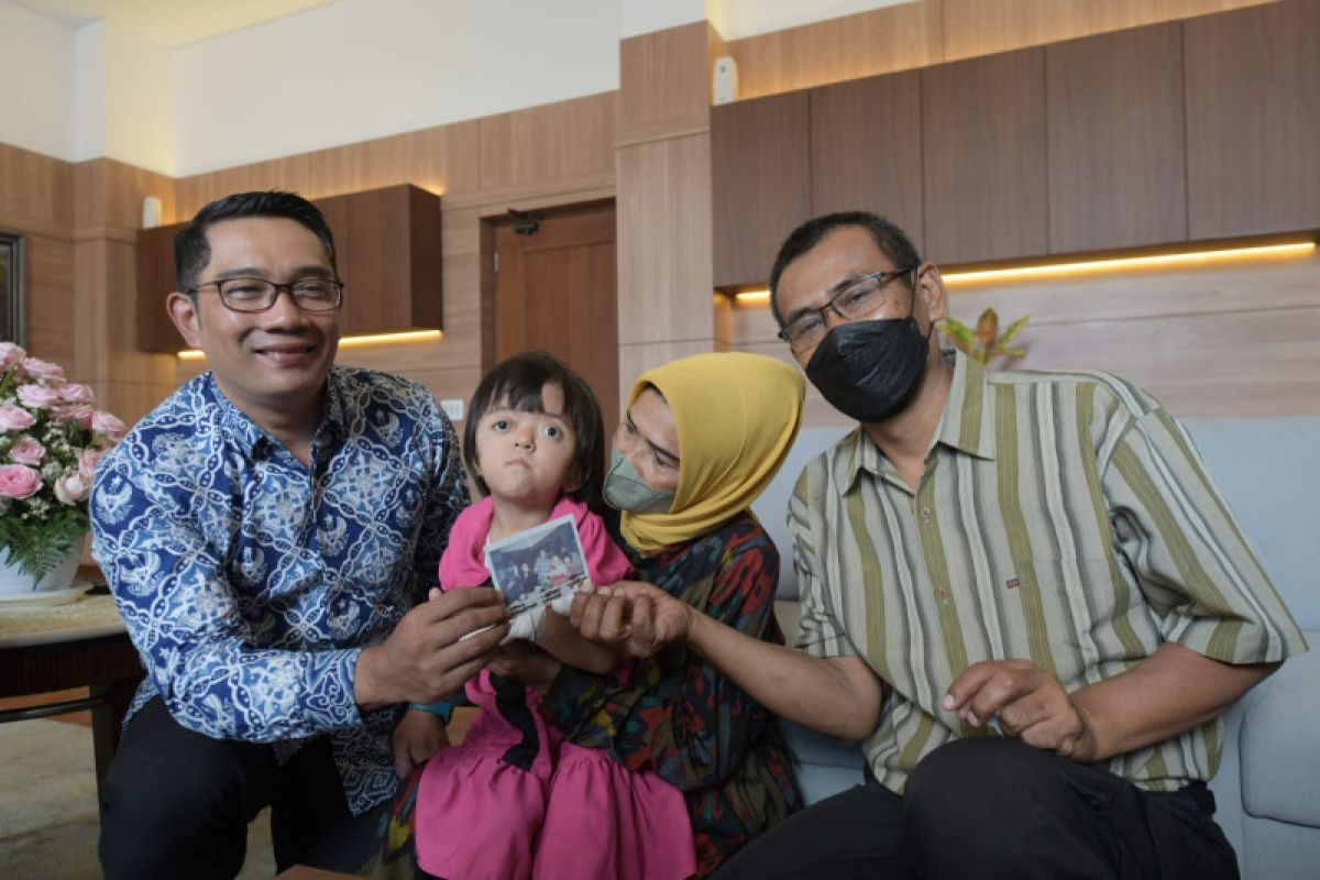 Gubernur Jabar beri bantuan balita pengidap Apert Syndrome