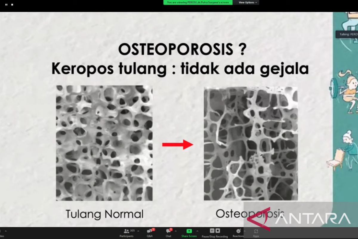 Pandemic has pushed up osteoporosis incidence: Perosi