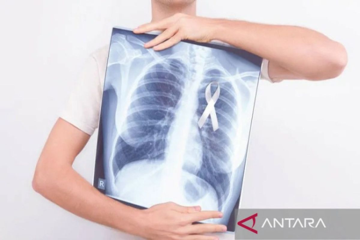 Dokter ingatkan sejumlah risiko penyebab kanker paru