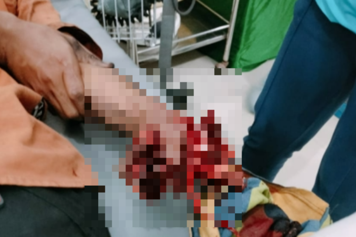 Tangan seorang pria cedera parah akibat petasan rakitan