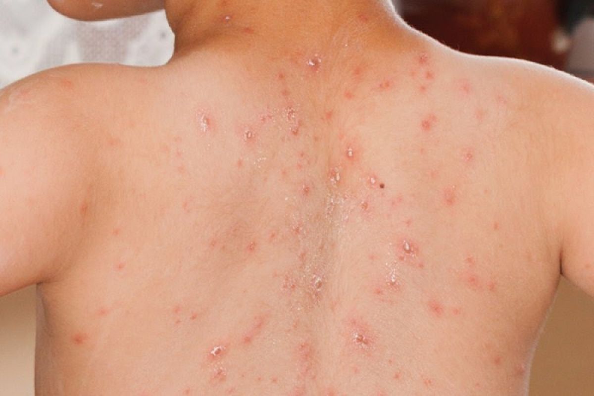 Measles outbreaks occur in 31 provinces: Health Ministry