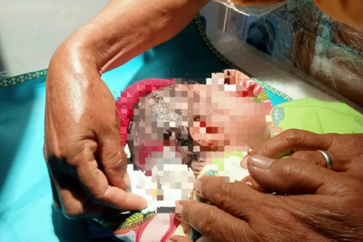 Seorang bayi di Lombok Tengah lahir dengan kondisi kepala bolong