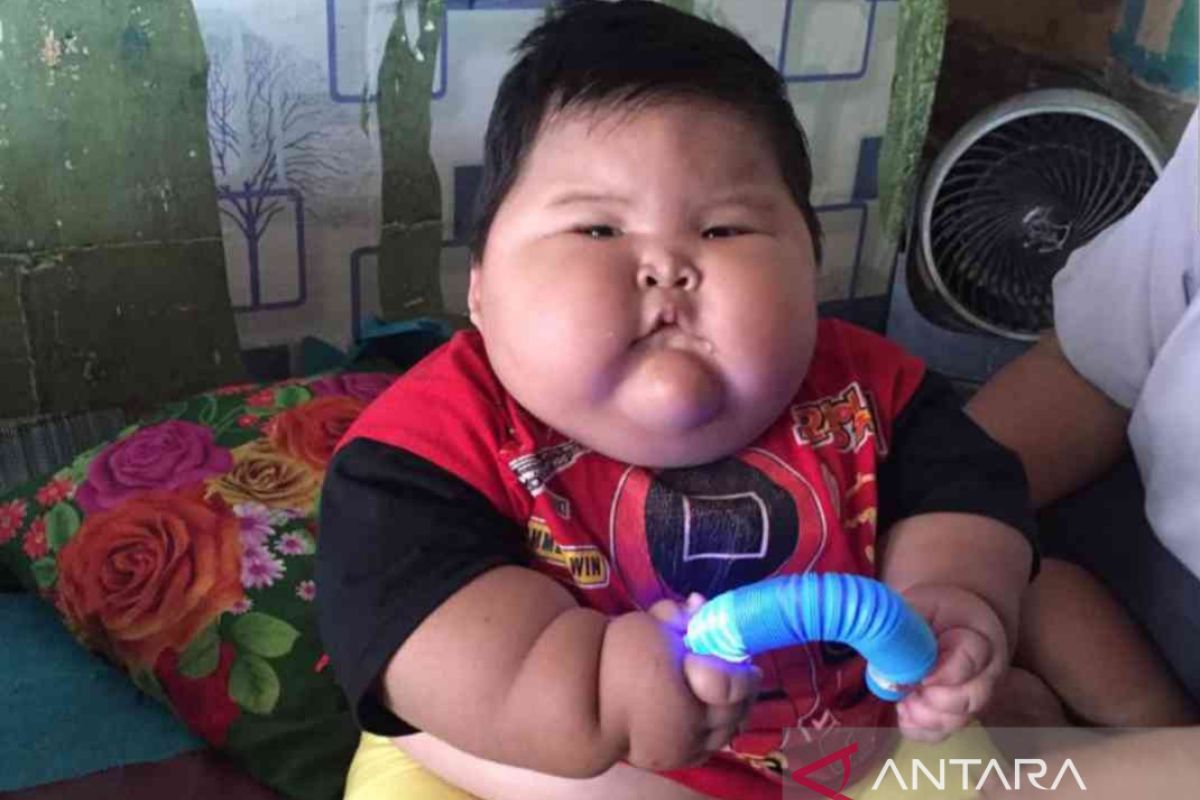 Menkes siap dampingi Kenzi balita obesitas asal Bekasi dengan perawatan