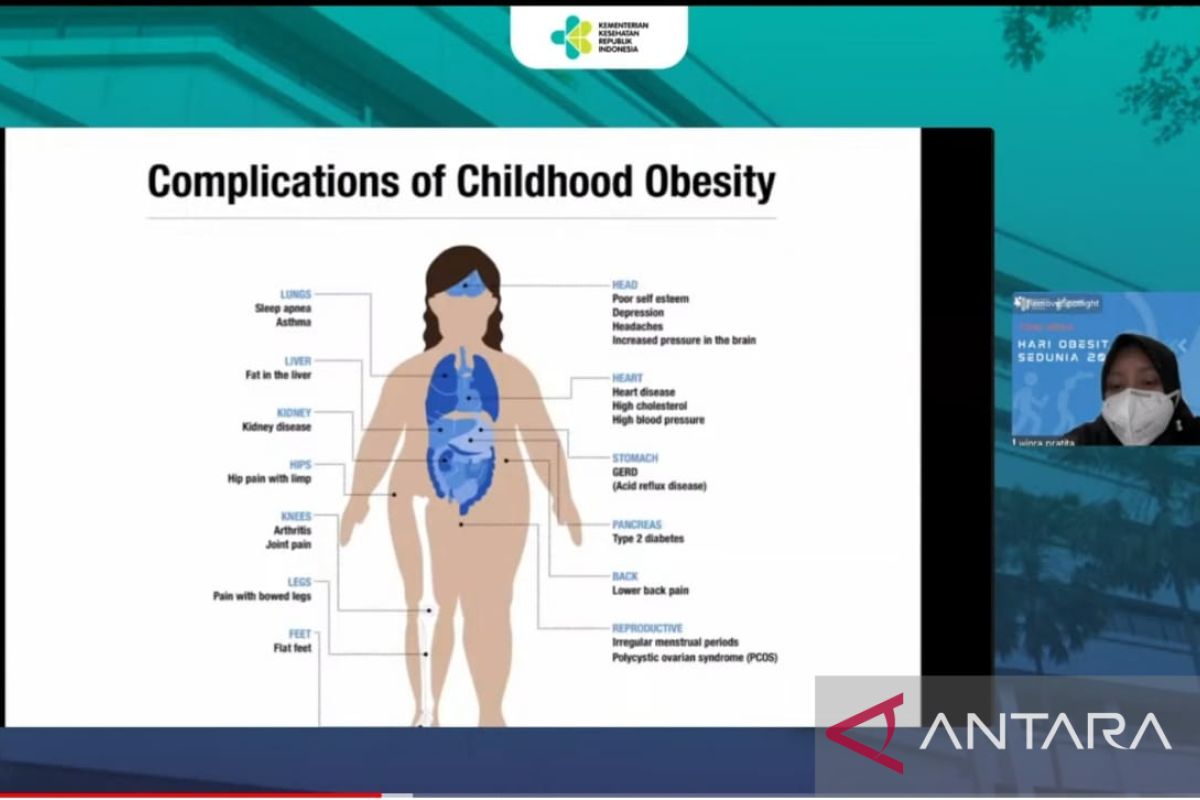 95 persen obesitas pada anak dipengaruhi masalah keseimbangan energi