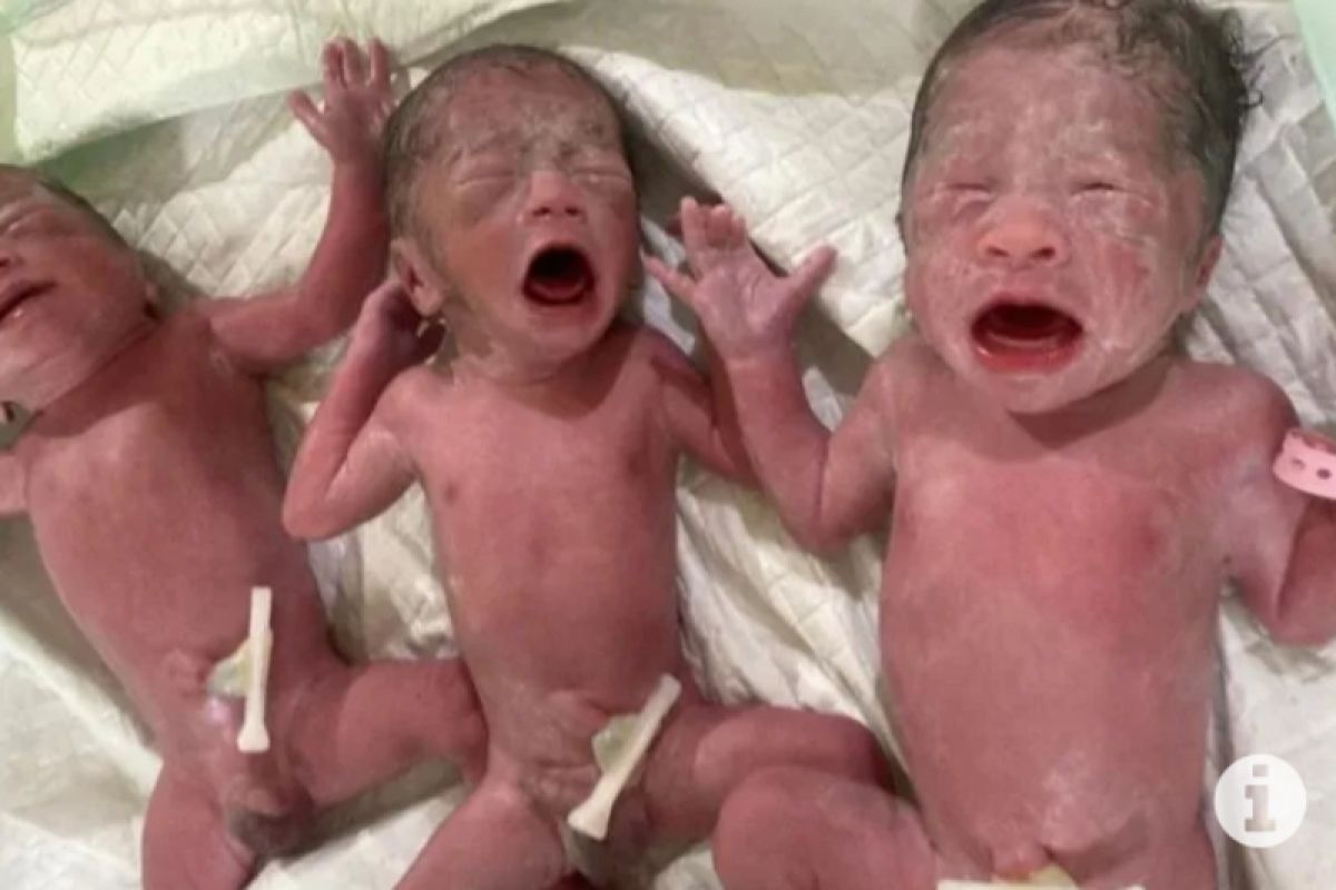 Bayi kembar tiga lahir dengan selamat di Paser, begini penjelasannya