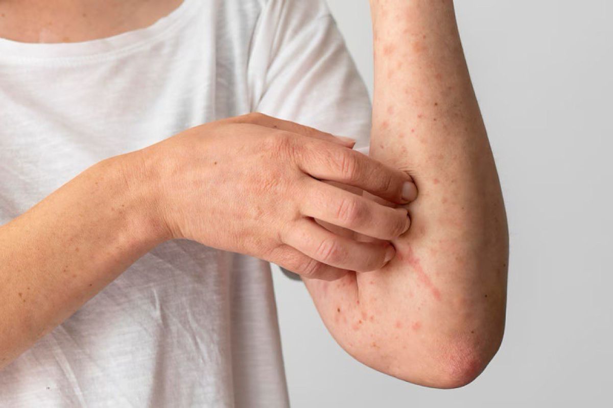 Kenali perbedaan lupus dengan alergi hingga gejalanya