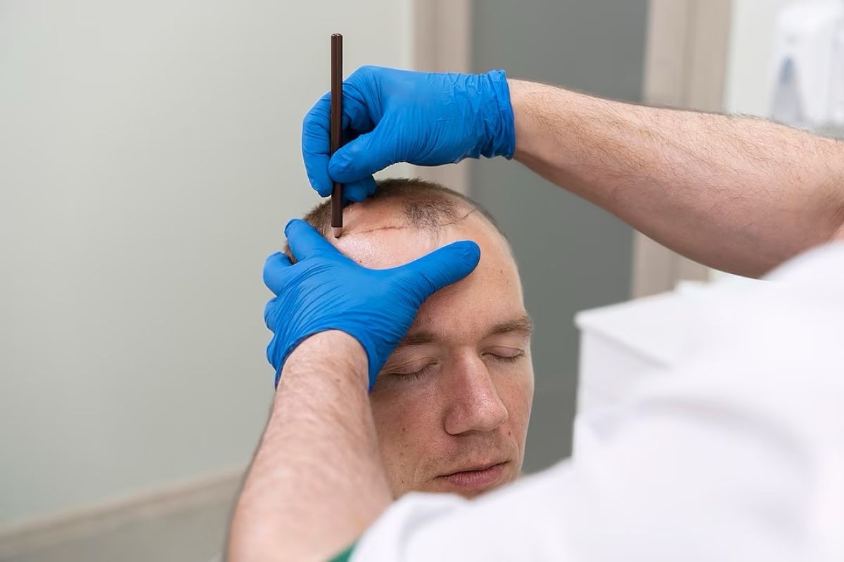 Mengenal transplantasi rambut, solusi untuk atasi kebotakan