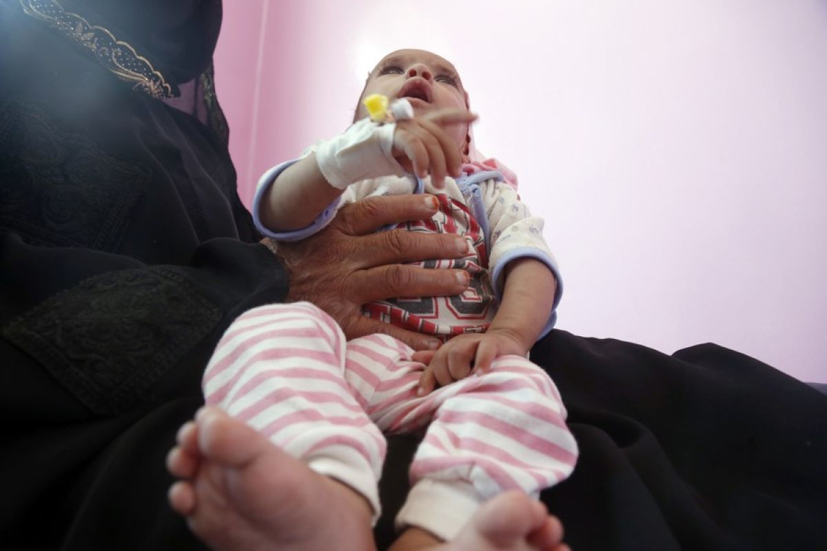 Kekurangan dana, WFP akan tangguhkan bantuan gizi buruk di Yaman