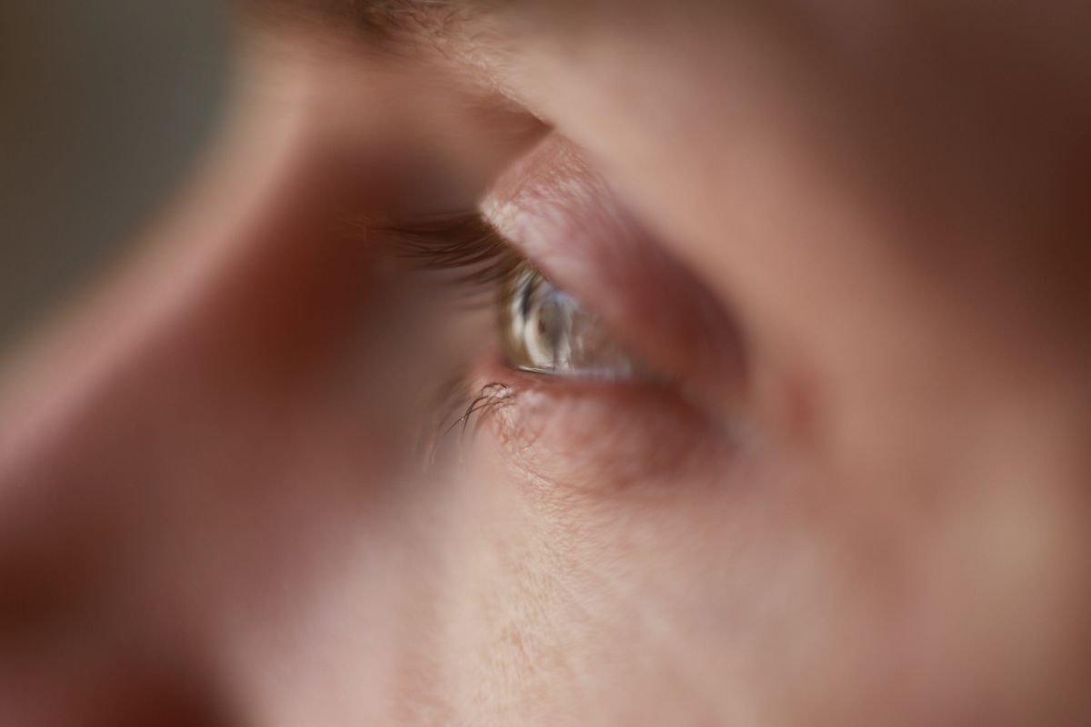 Mirip bintitan, waspadai gejala tumor kelopak mata