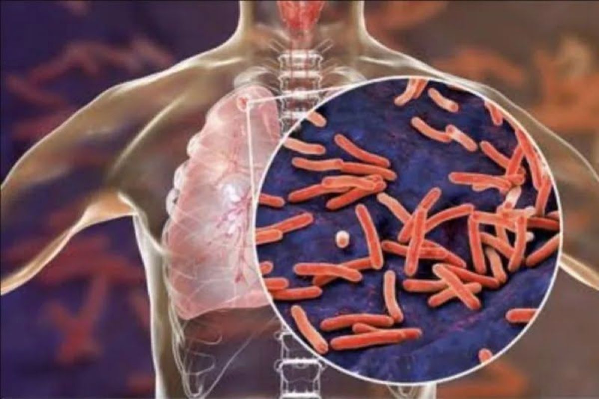 Legislator dorong penurunan angka penderita tuberkulosis