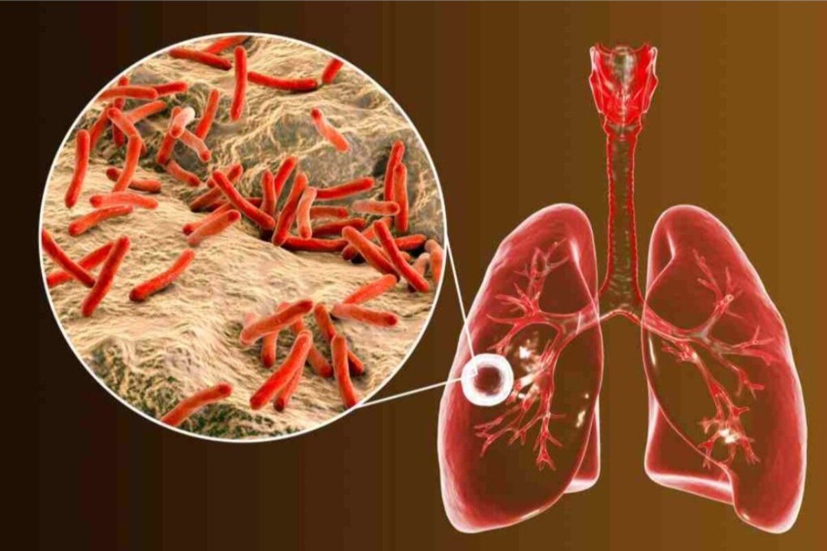 Dinas Kesehatan Pesisir Barat tangani 166 kasus TB dari Januari-Oktober 2023