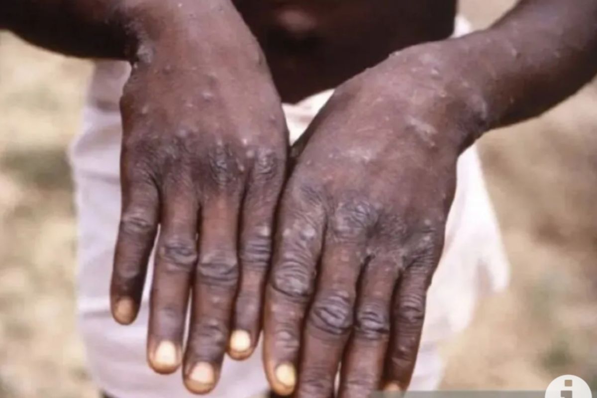 All 24 monkeypox patients are mildly symptomatic males: Official