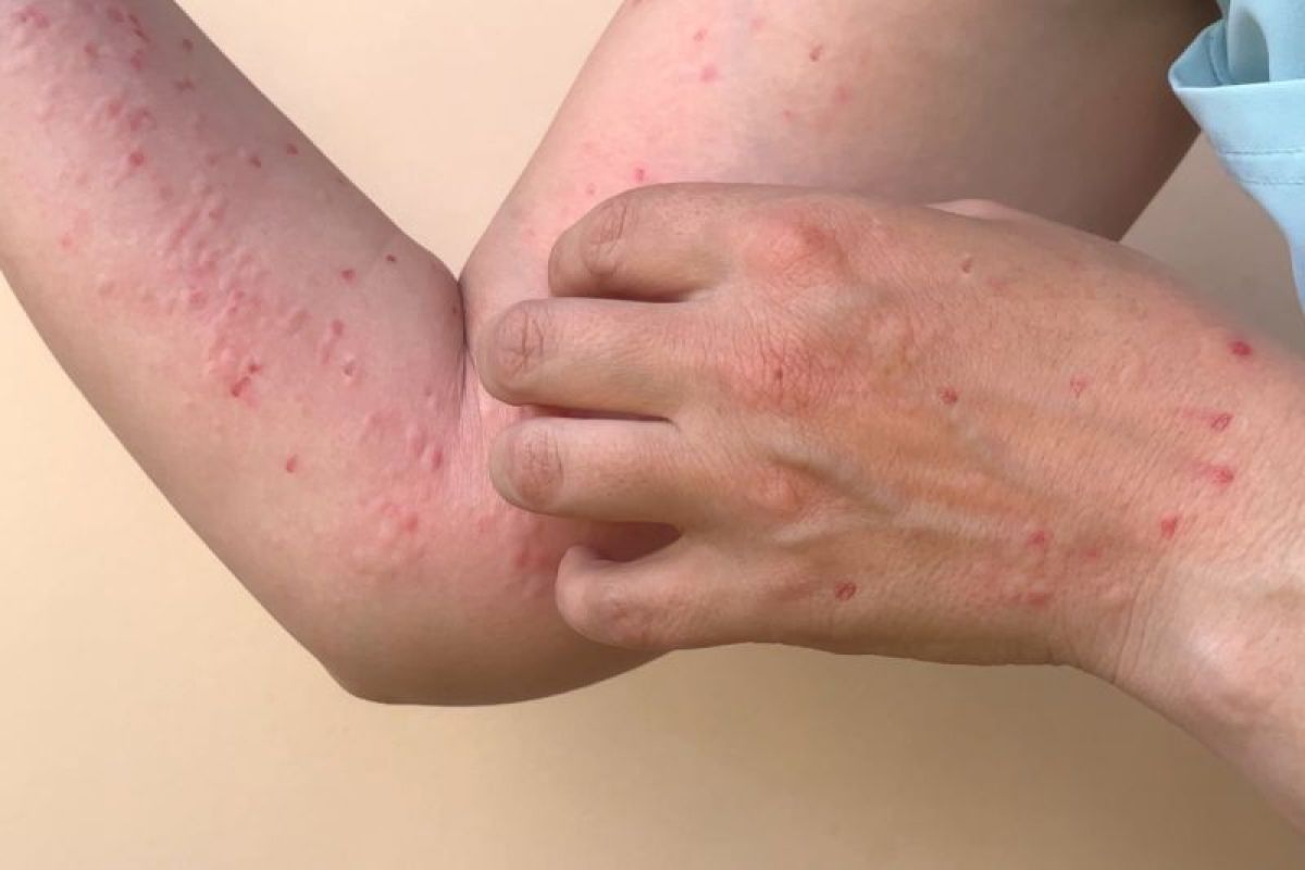 Kelainan kulit bukan diduga alergi harus curiga Mpox